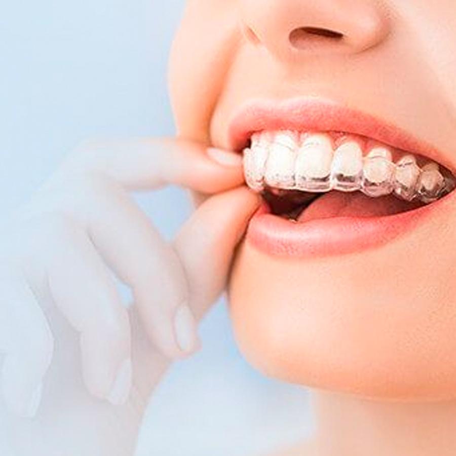 Invisalign clear aligners from Smiley Dental